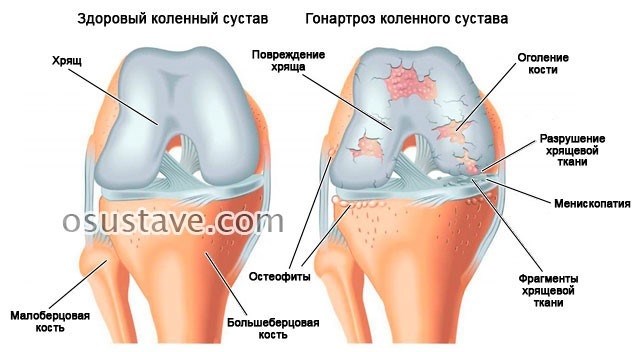 Индивидуальная программа реабилитации (ИПР)